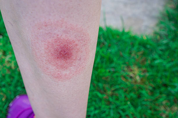 Lyme Disease