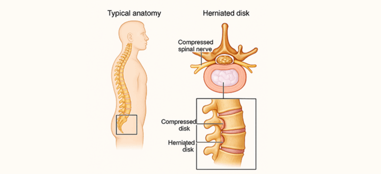 Herniated Disc & Back Pain