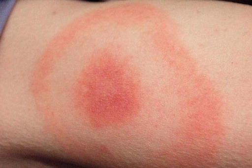 Lyme disease symptoms and holistic wellness awareness illustration