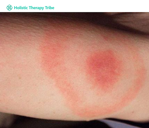 Lyme disease skin rashes