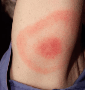 bug bite