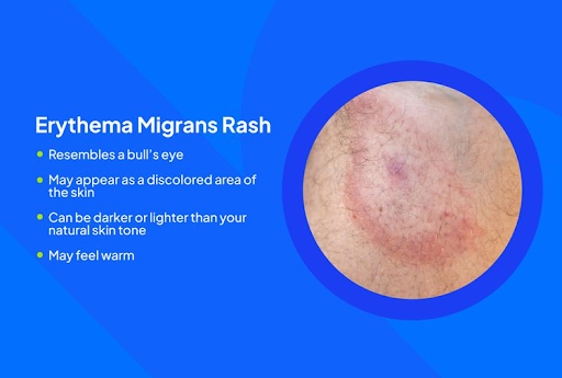 lyme-disease-happen-without-a-rash