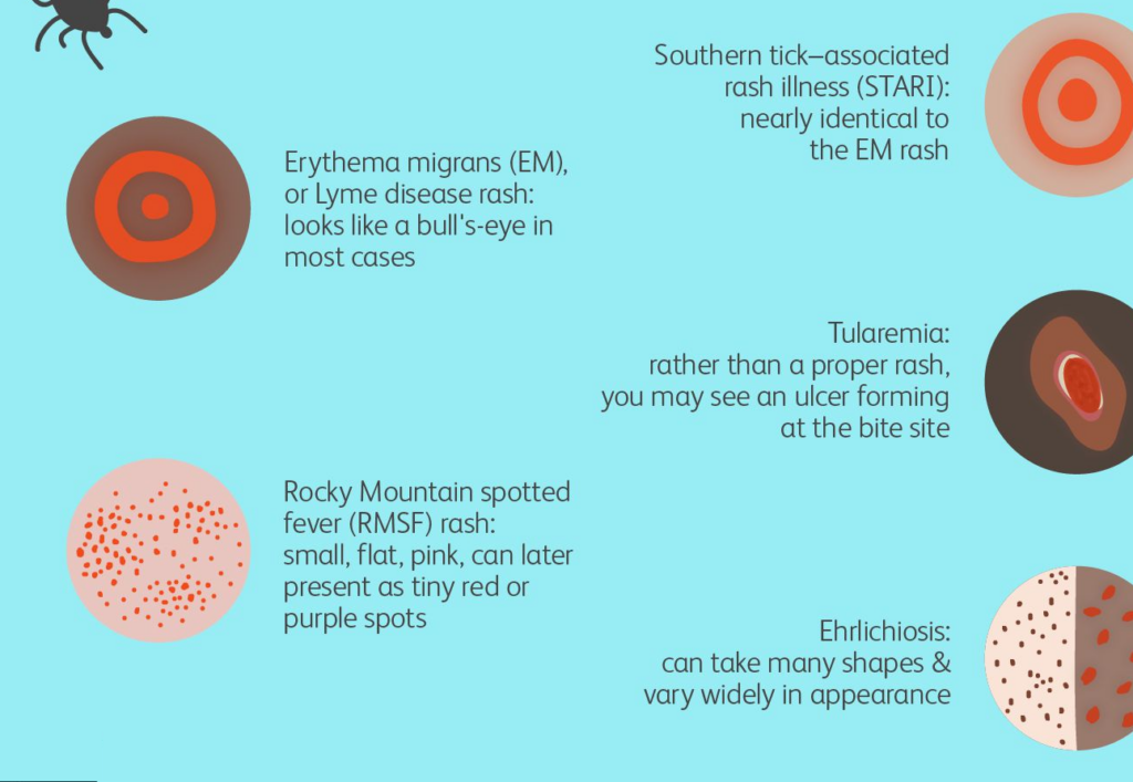 why-is-the-tick-bite-rash